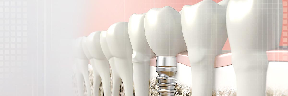 LA Dental Arts - Bershadsky DDS - Los Angeles Dentist - Composite Fillings Header LA Dental Arts - Bershadsky DDS - Los Angeles Dentist - Composite Fillings Header