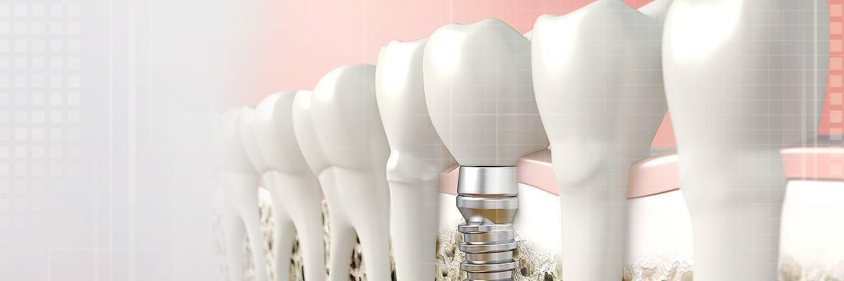 dental-implants-header
