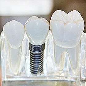 dental-implants