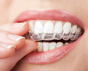 LA Dental Arts-Bershadsky DDS-Los Angeles Dentist-does invisalign really work LA Dental Arts-Bershadsky DDS-Los Angeles Dentist-does invisalign really work