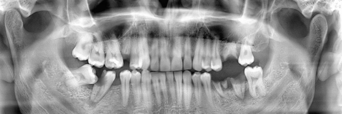 LA Dental Arts-Bershadsky DDS-Los Angeles Dentist-options for replacing missing teeth header LA Dental Arts-Bershadsky DDS-Los Angeles Dentist-options for replacing missing teeth header
