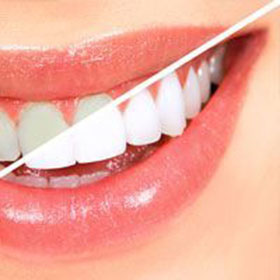 professional-teeth-whitening